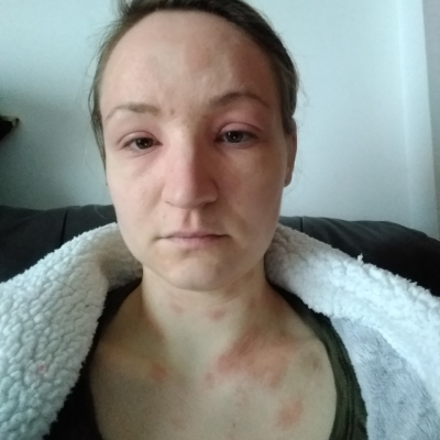 Women with skin blotches and puffy face from MCAS reaction
