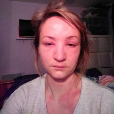 Women with puffy face from MCAS reaction