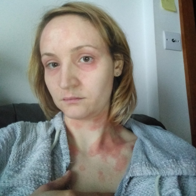 Women with blotch skin on neck and torso from MCAS reaction