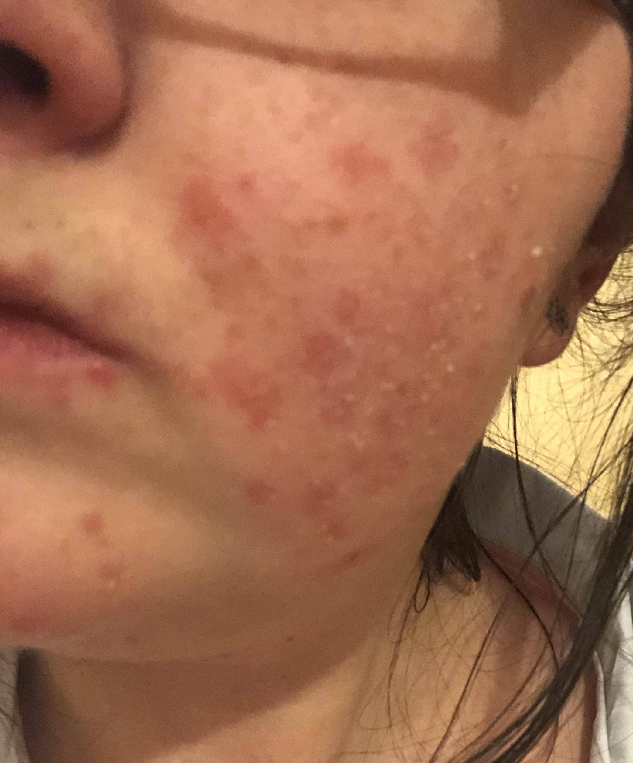 A swollen red face with a rash from MCAS reaction