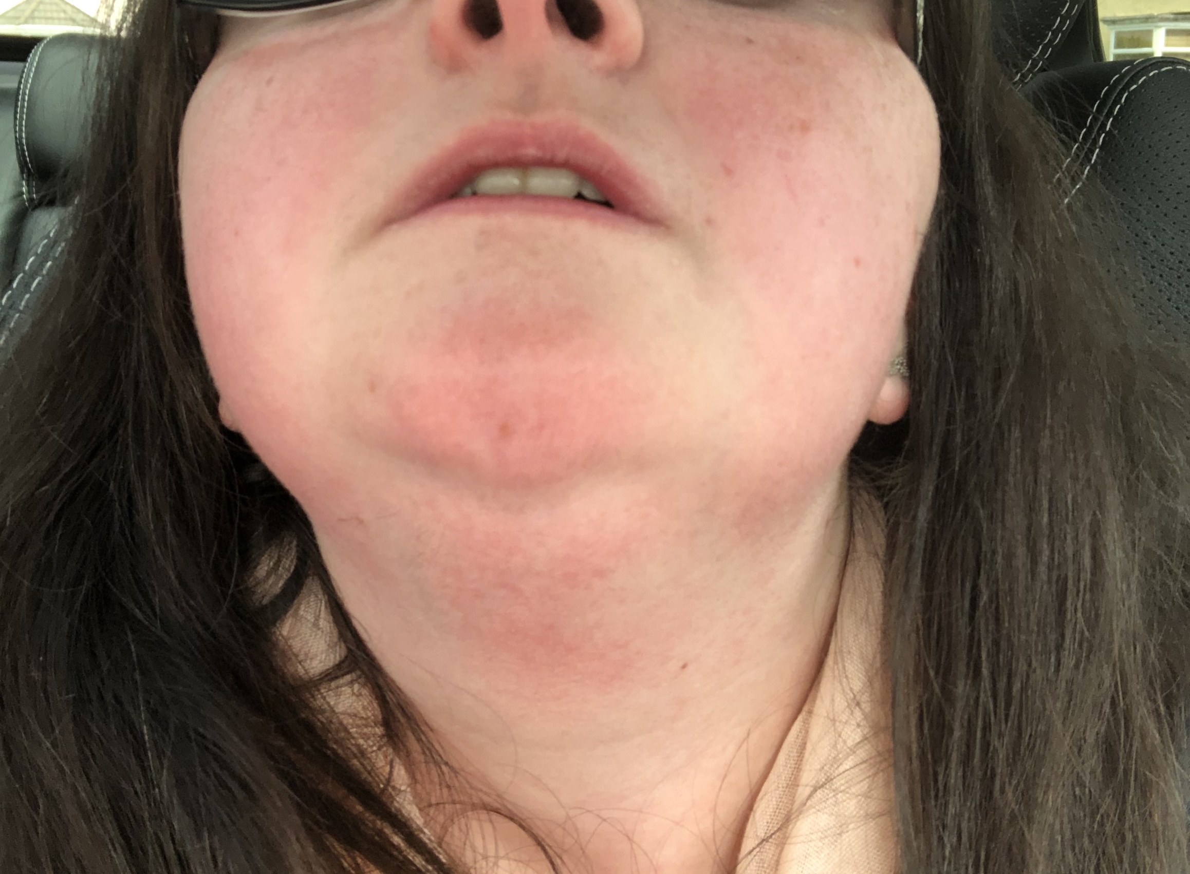 Picture of Tasmin's face with an MCAS reaction - a red rash