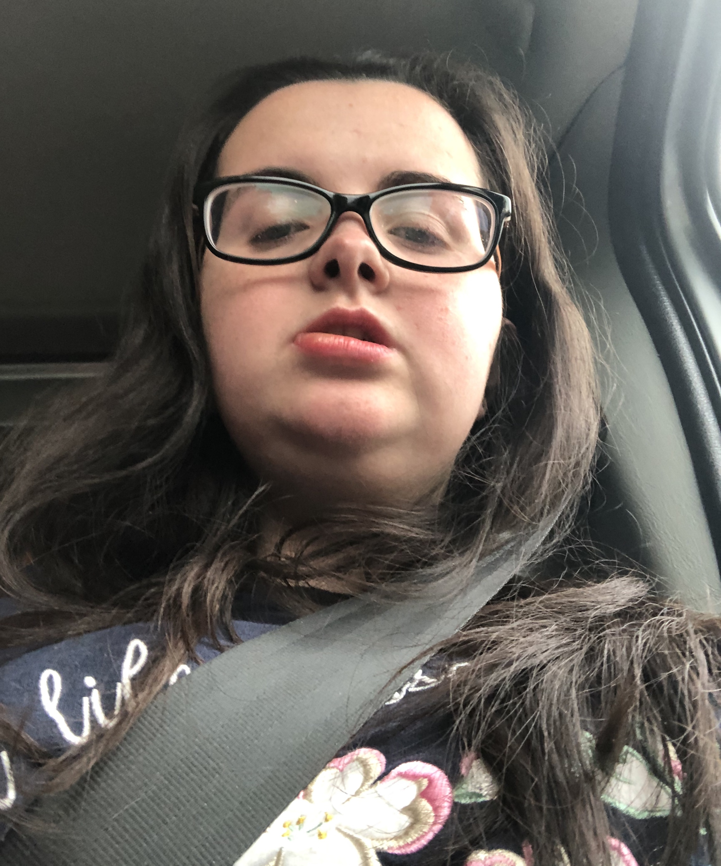 Tasmin, a young women with MCAS with swollen lips after an MCAS reaction